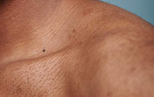 Taches foncées et hyperpigmentation sur la peau noire
