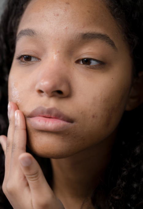 Acné adulte sur peau noire : comprendre les causes et agir sans agresser